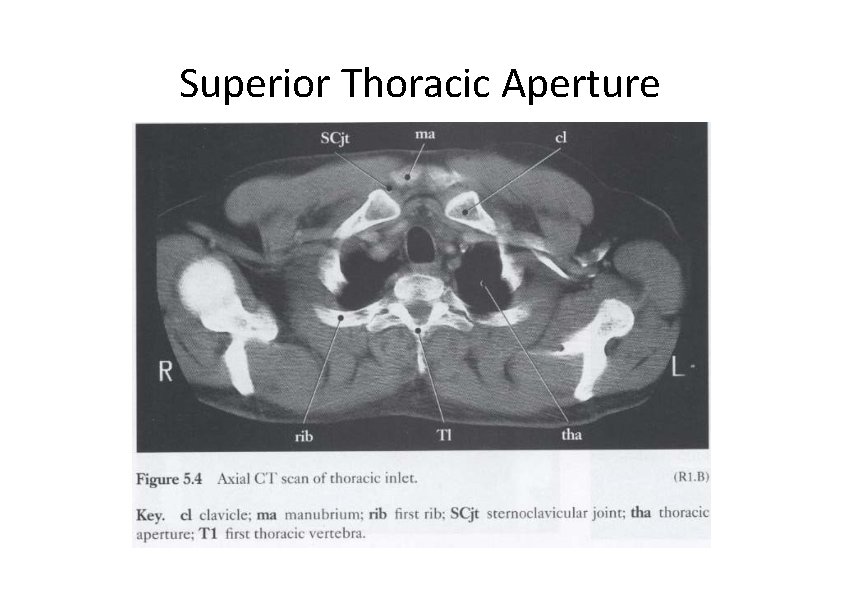 Superior Thoracic Aperture 