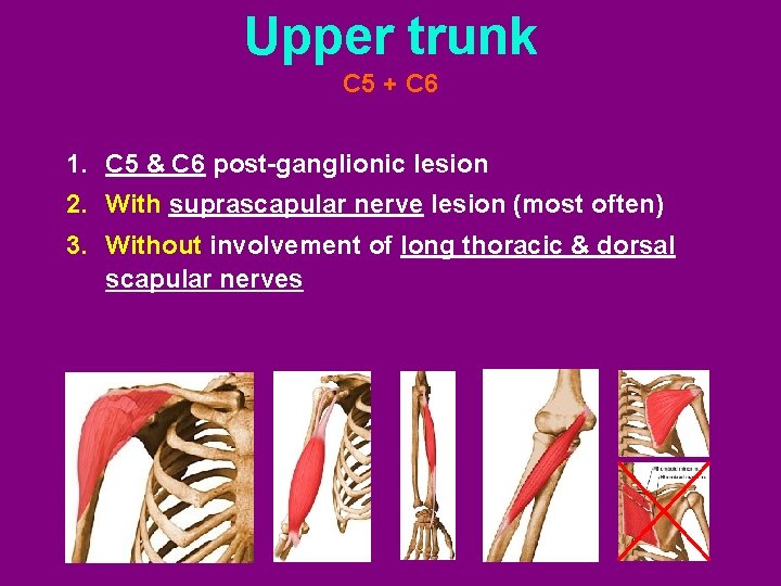 Upper trunk C 5 + C 6 1. C 5 & C 6 post-ganglionic