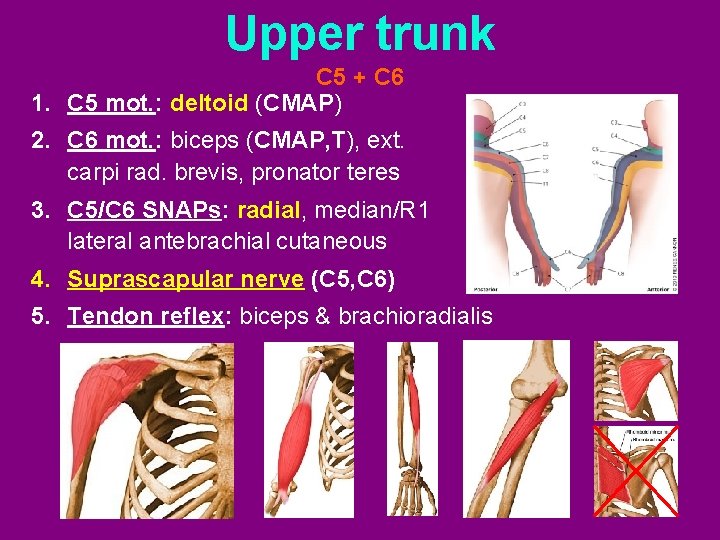 Upper trunk C 5 + C 6 1. C 5 mot. : deltoid (CMAP)