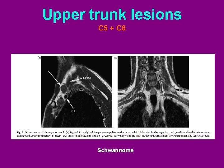 Upper trunk lesions C 5 + C 6 Schwannome 