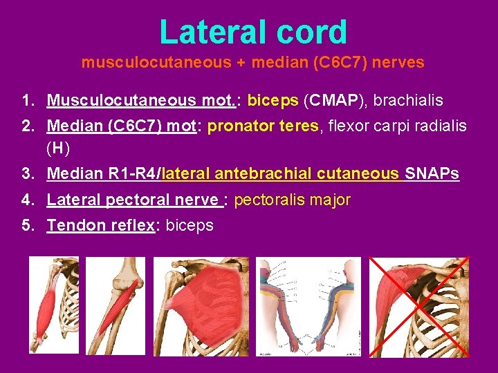 Lateral cord musculocutaneous + median (C 6 C 7) nerves 1. Musculocutaneous mot. :