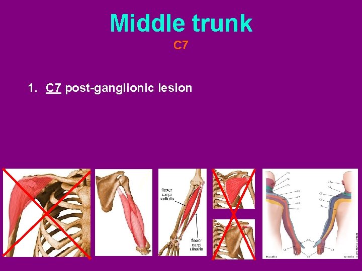 Middle trunk C 7 1. C 7 post-ganglionic lesion 