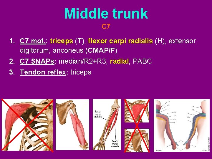 Middle trunk C 7 1. C 7 mot. : triceps (T), flexor carpi radialis