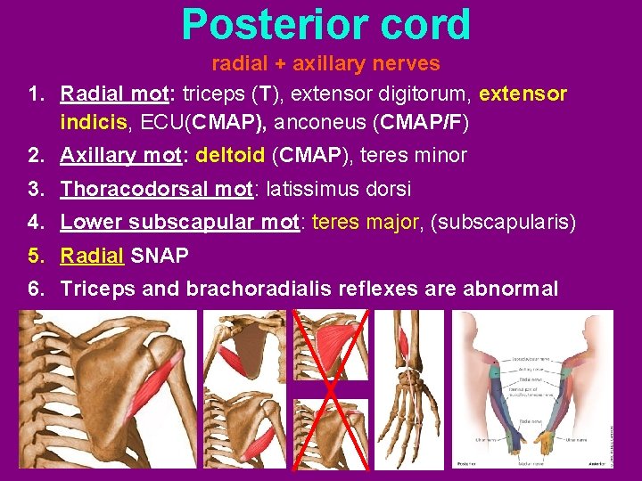 Posterior cord radial + axillary nerves 1. Radial mot: triceps (T), extensor digitorum, extensor