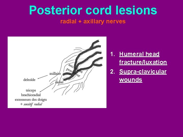 Posterior cord lesions radial + axillary nerves 1. Humeral head fracture/luxation 2. Supra-clavicular wounds