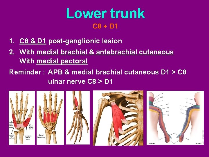 Lower trunk C 8 + D 1 1. C 8 & D 1 post-ganglionic