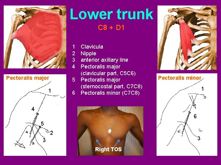 Lower trunk C 8 + D 1 1 2 3 4 Pectoralis major 1