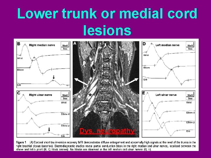Lower trunk or medial cord lesions Dys. neuropathy 