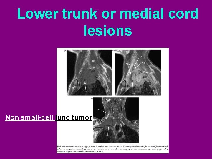Lower trunk or medial cord lesions Non small-cell lung tumor 