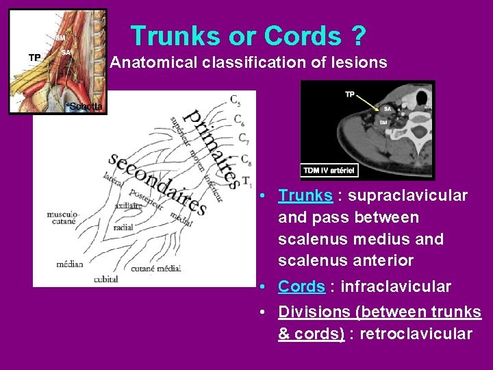 Trunks or Cords ? Anatomical classification of lesions • Trunks : supraclavicular and pass