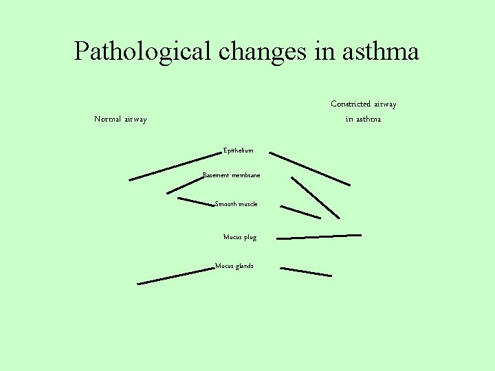 Pathological changes in asthma Constricted airway in asthma Normal airway Epithelium Basement membrane Smooth