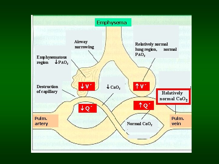 Emphysema Airway narrowing Relatively normal lung region, normal PAO 2 Emphysematous region PAO 2