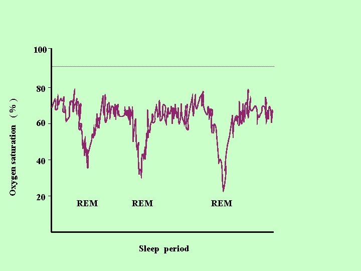 100 Oxygen saturation ( % ) 80 60 40 20 REM Sleep period REM