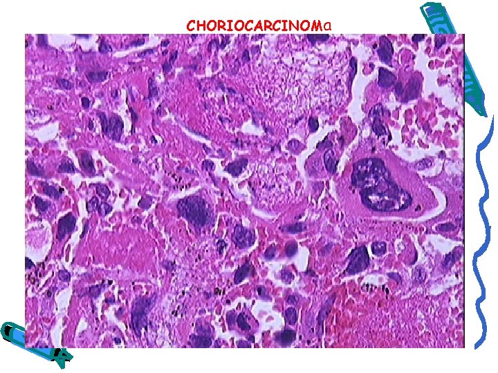 CHORIOCARCINOMa 