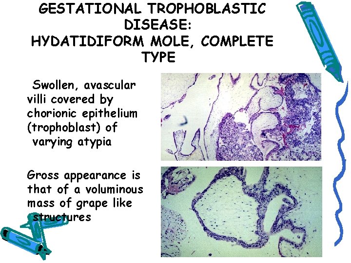 GESTATIONAL TROPHOBLASTIC DISEASE: HYDATIDIFORM MOLE, COMPLETE TYPE Swollen, avascular villi covered by chorionic epithelium