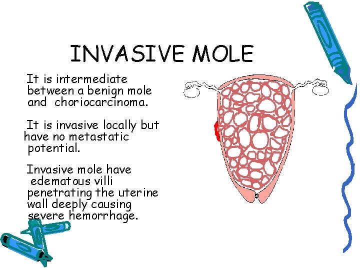 INVASIVE MOLE It is intermediate between a benign mole and choriocarcinoma. It is invasive