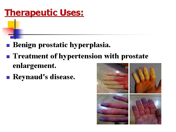 Therapeutic Uses: n n n Benign prostatic hyperplasia. Treatment of hypertension with prostate enlargement.