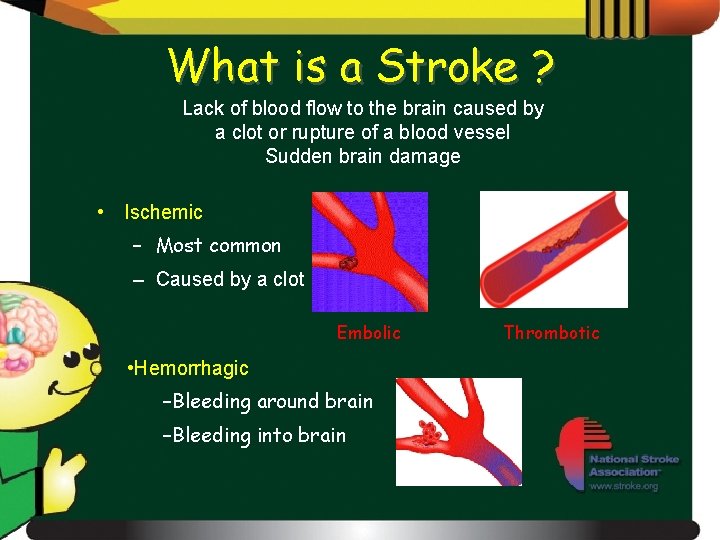 What is a Stroke ? Lack of blood flow to the brain caused by