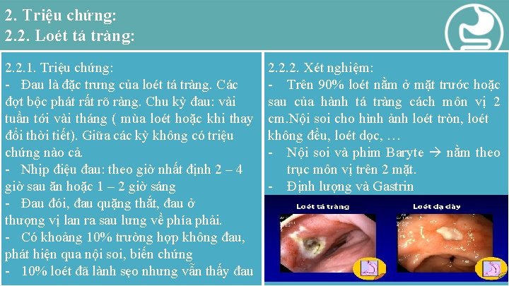 2. Triệu chứng: 2. 2. Loét tá tràng: 2. 2. 1. Triệu chứng: -