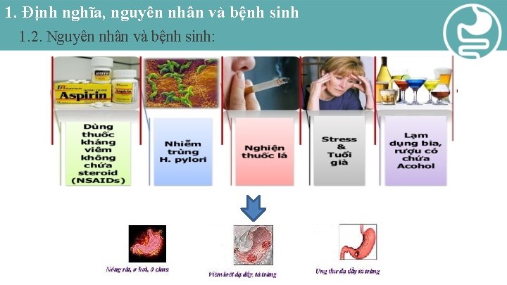 1. Định nghĩa, nguyên nhân và bệnh sinh 1. 2. Nguyên nhân và bệnh
