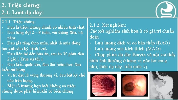 2. Triệu chứng: 2. 1. Loét dạ dày: 2. 1. 1. Triệu chứng: -