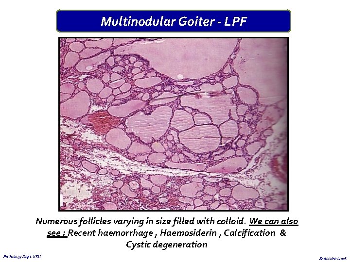 Multinodular Goiter - LPF Numerous follicles varying in size filled with colloid. We can