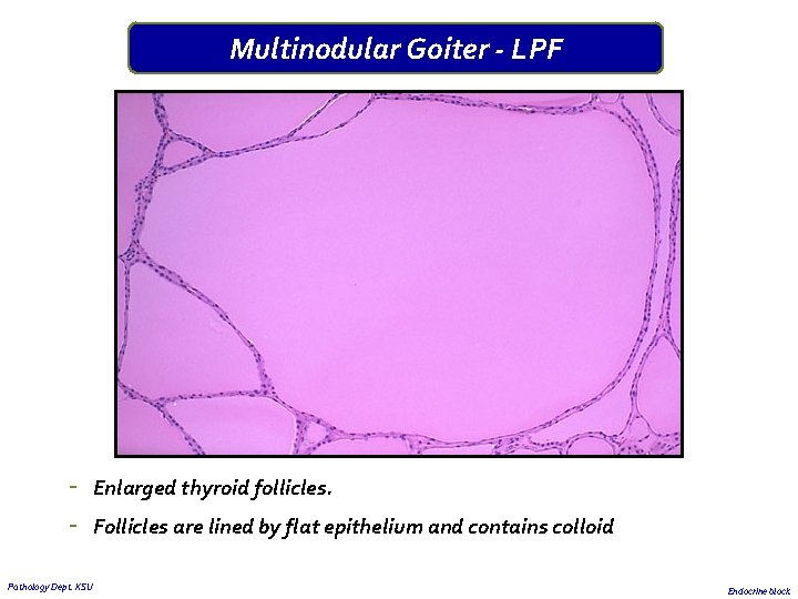 Multinodular Goiter - LPF - Enlarged thyroid follicles. Follicles are lined by flat epithelium