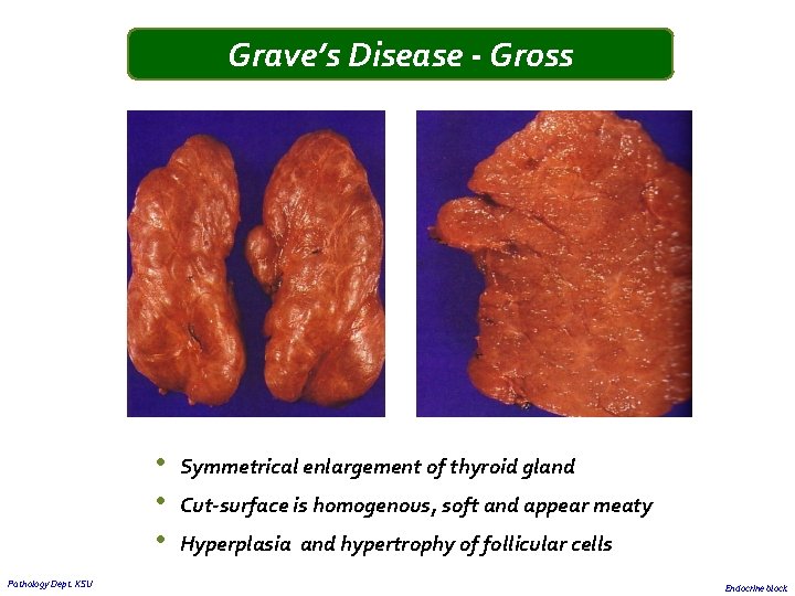 Grave’s Disease - Gross • • • Pathology Dept. KSU Symmetrical enlargement of thyroid