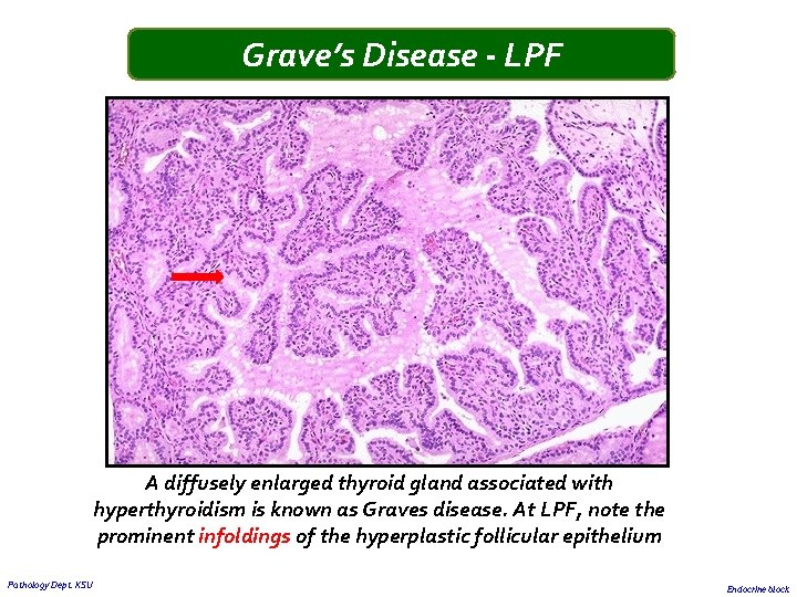 Grave’s Disease - LPF A diffusely enlarged thyroid gland associated with hyperthyroidism is known