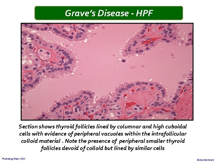 Grave’s Disease - HPF Section shows thyroid follicles lined by columnar and high cuboidal Grave’s Disease - HPF Section shows thyroid follicles lined by columnar and high cuboidal