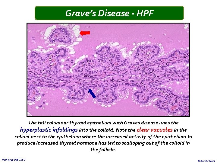 Grave’s Disease - HPF The tall columnar thyroid epithelium with Graves disease lines the