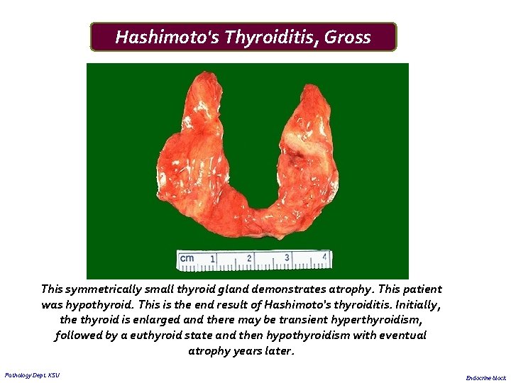 Hashimoto's Thyroiditis, Gross This symmetrically small thyroid gland demonstrates atrophy. This patient was hypothyroid. Hashimoto's Thyroiditis, Gross This symmetrically small thyroid gland demonstrates atrophy. This patient was hypothyroid.