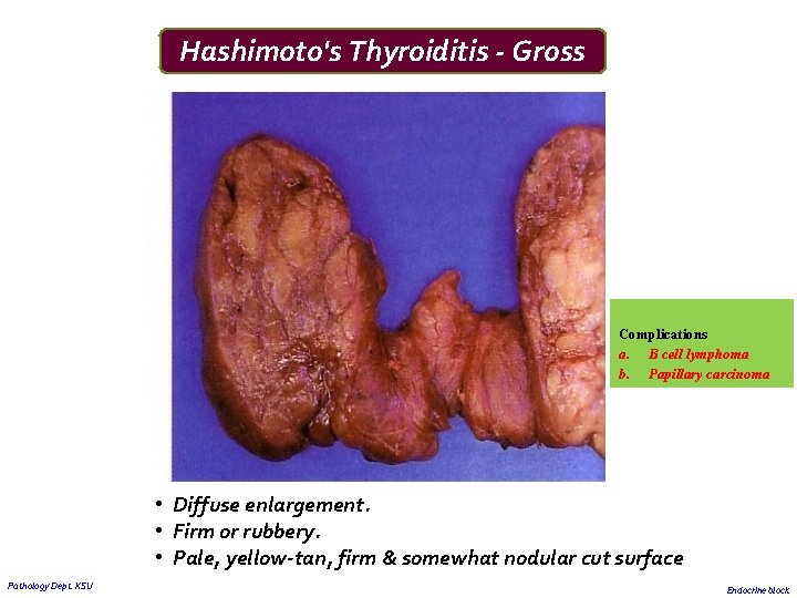 Hashimoto's Thyroiditis - Gross Complications a. B cell lymphoma b. Papillary carcinoma • Diffuse