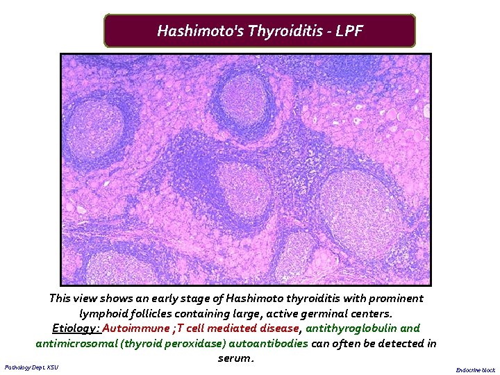 Hashimoto's Thyroiditis - LPF This view shows an early stage of Hashimoto thyroiditis with
