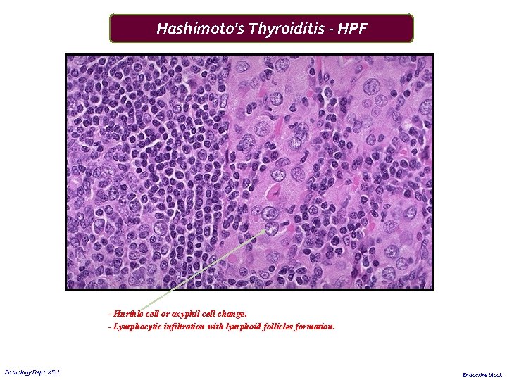 Hashimoto's Thyroiditis - HPF - Hurthle cell or oxyphil cell change. - Lymphocytic infiltration