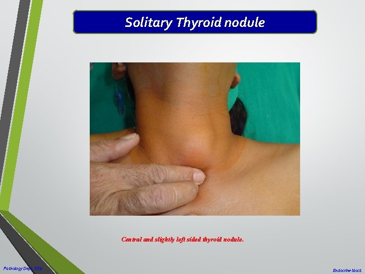Solitary Thyroid nodule Central and slightly left sided thyroid nodule. Pathology Dept. KSU Endocrine