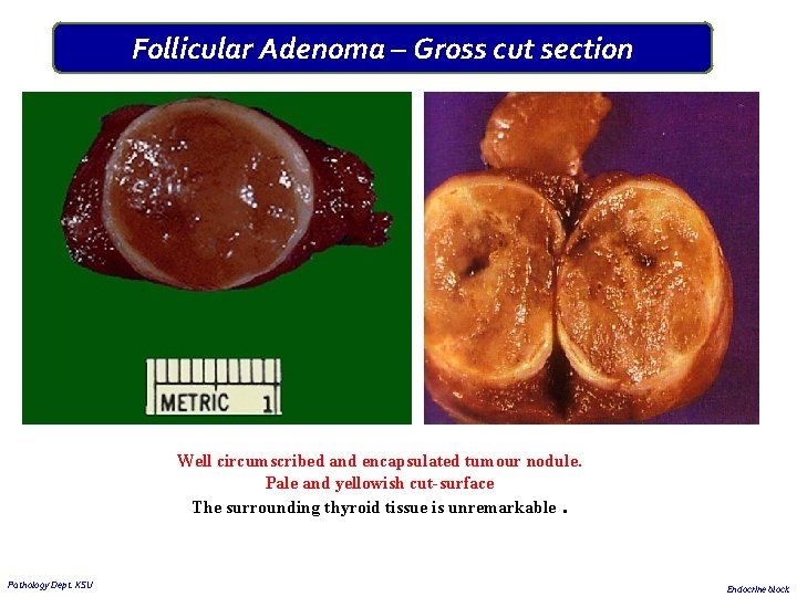 Follicular Adenoma – Gross cut section Well circumscribed and encapsulated tumour nodule. Pale and Follicular Adenoma – Gross cut section Well circumscribed and encapsulated tumour nodule. Pale and