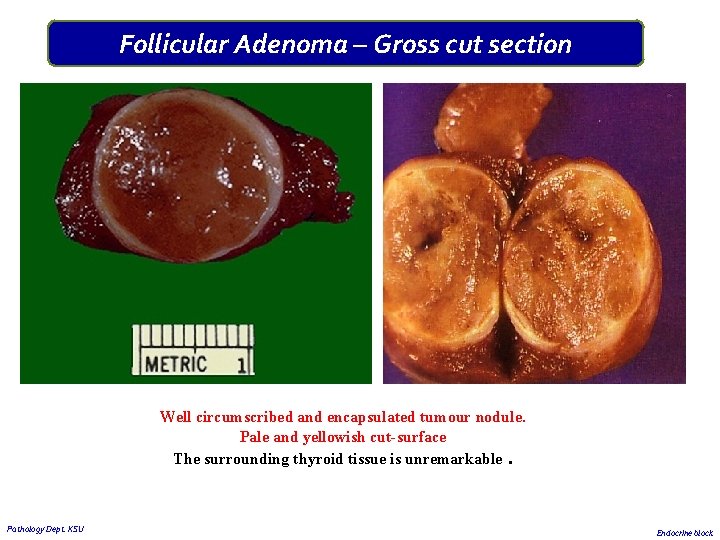 Follicular Adenoma – Gross cut section Well circumscribed and encapsulated tumour nodule. Pale and