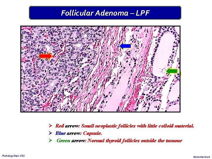 Follicular Adenoma – LPF Ø Red arrow: Small neoplastic follicles with little colloid material. Follicular Adenoma – LPF Ø Red arrow: Small neoplastic follicles with little colloid material.