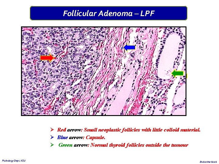 Follicular Adenoma – LPF Ø Red arrow: Small neoplastic follicles with little colloid material.