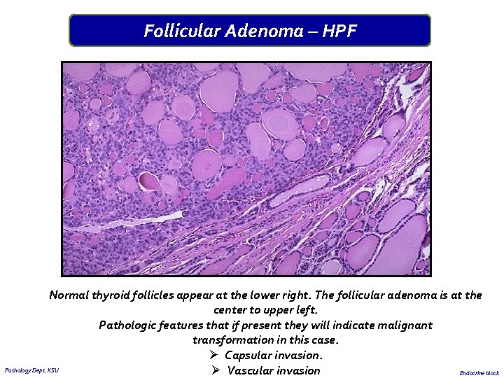 Follicular Adenoma – HPF Normal thyroid follicles appear at the lower right. The follicular Follicular Adenoma – HPF Normal thyroid follicles appear at the lower right. The follicular