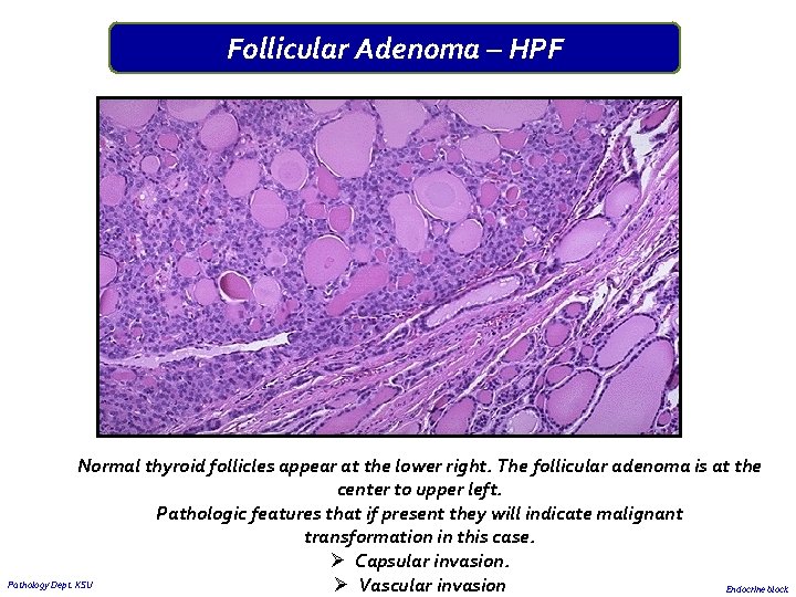 Follicular Adenoma – HPF Normal thyroid follicles appear at the lower right. The follicular