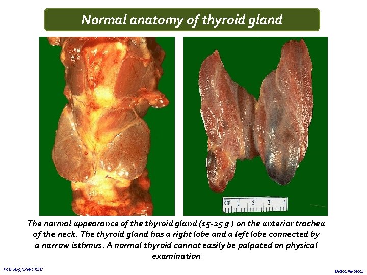 Normal anatomy of thyroid gland The normal appearance of the thyroid gland (15 -25 Normal anatomy of thyroid gland The normal appearance of the thyroid gland (15 -25