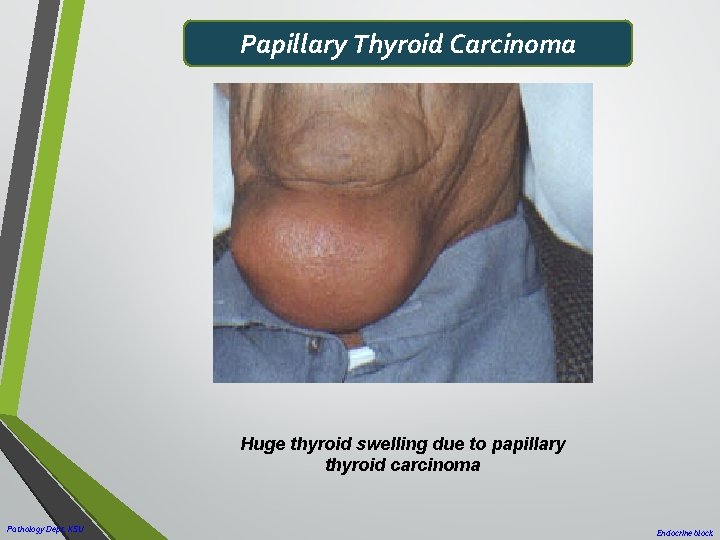 Papillary Thyroid Carcinoma Huge thyroid swelling due to papillary thyroid carcinoma Pathology Dept. KSU