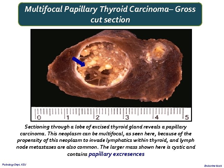 Multifocal Papillary Thyroid Carcinoma– Gross cut section Sectioning through a lobe of excised thyroid Multifocal Papillary Thyroid Carcinoma– Gross cut section Sectioning through a lobe of excised thyroid