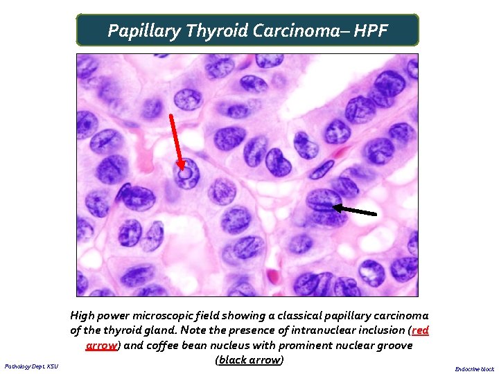 Papillary Thyroid Carcinoma– HPF Pathology Dept. KSU High power microscopic field showing a classical