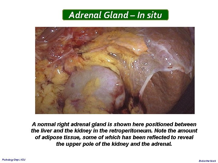 Adrenal Gland – In situ A normal right adrenal gland is shown here positioned