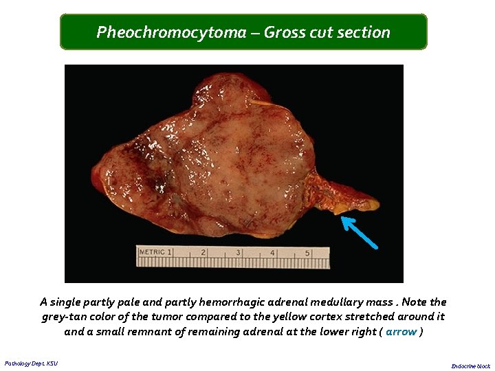Pheochromocytoma – Gross cut section A single partly pale and partly hemorrhagic adrenal medullary Pheochromocytoma – Gross cut section A single partly pale and partly hemorrhagic adrenal medullary