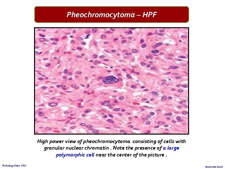 Pheochromocytoma – HPF High power view of pheochromocytoma consisting of cells with granular nuclear Pheochromocytoma – HPF High power view of pheochromocytoma consisting of cells with granular nuclear
