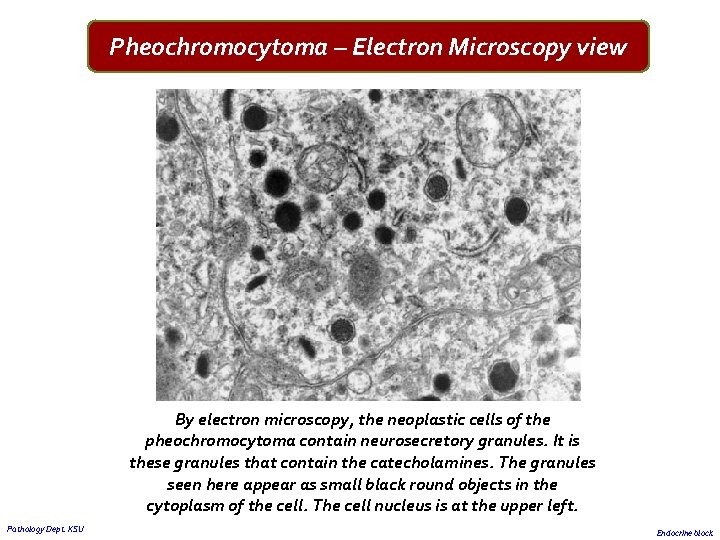 Pheochromocytoma – Electron Microscopy view By electron microscopy, the neoplastic cells of the pheochromocytoma